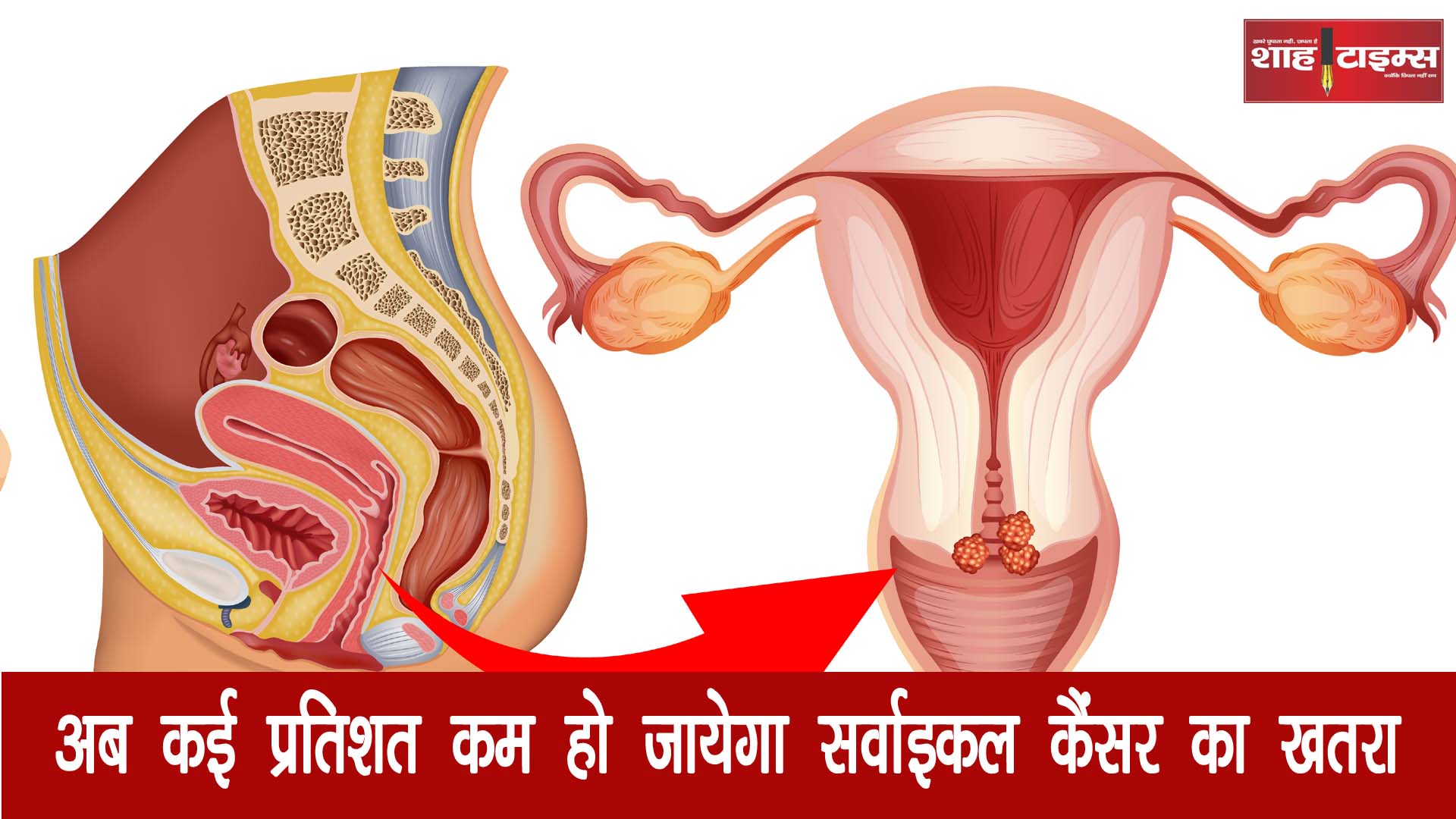 अब कई प्रतिशत कम हो जाएगा सर्वाइकल कैंसर का खतरा, नए शोध में हुआ खुलासा